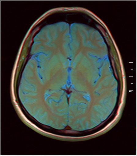 File:Brain MRI 0249 09.jpg