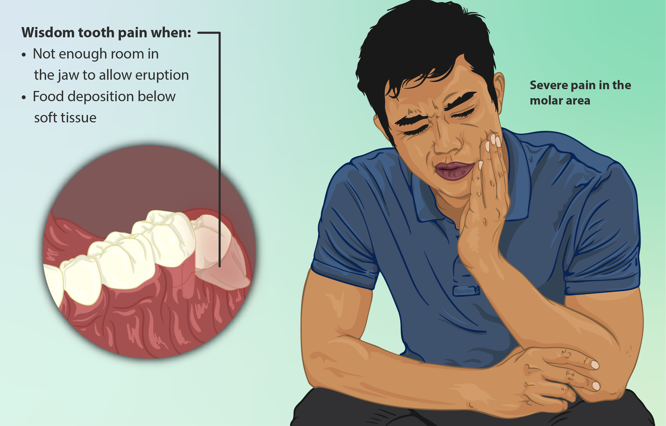 Depiction of a man suffering from wisdom tooth pain.png. 
