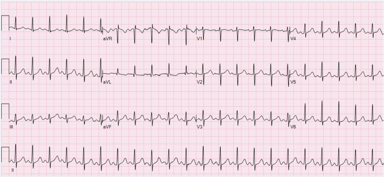 File Ecg Sinus Tachycardia 132 Bpm Jpg Wikimedia Commons