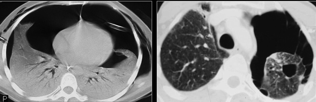 CT of bilateral pneumothoraces by pneumocystis pneumonia cysts