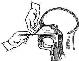 <span class="mw-page-title-main">Nasopharyngeal swab</span>