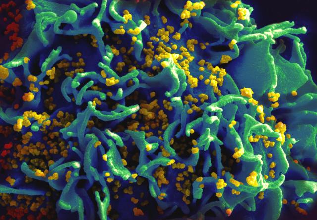 File:HIV-infected H9 T cell2.jpg