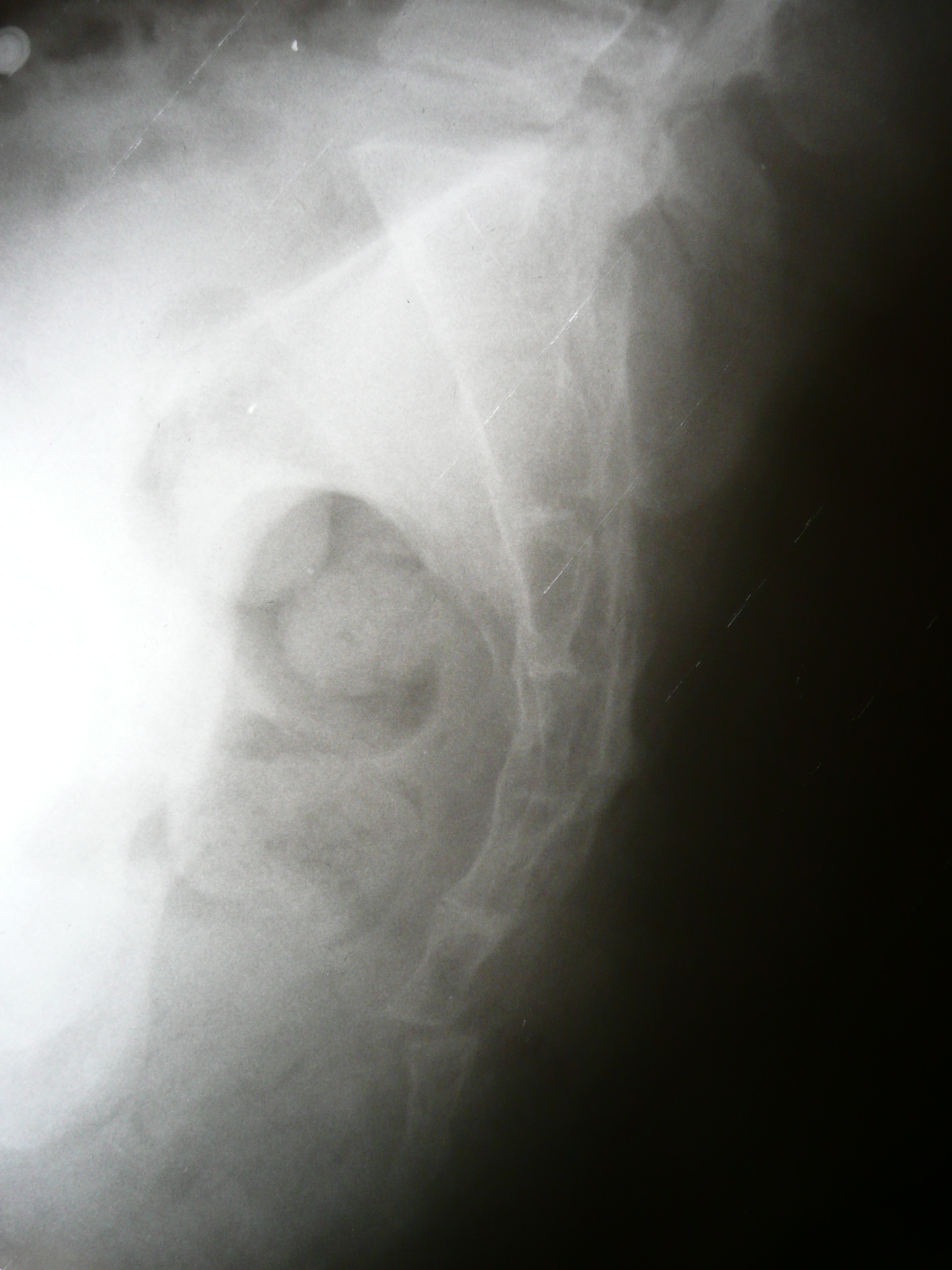 dislocation of coccyx rectal