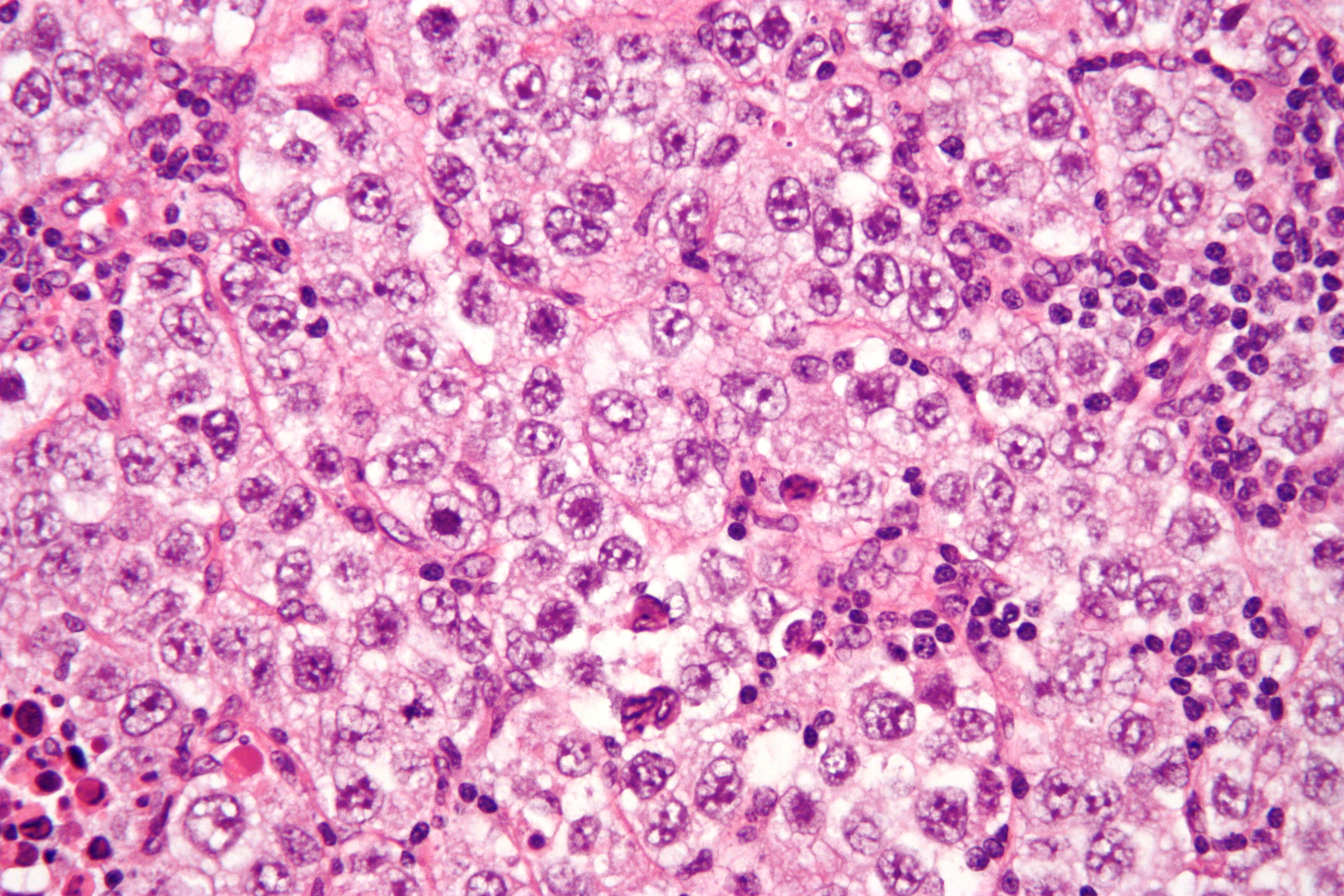 Germ cell tumor - Wikipedia