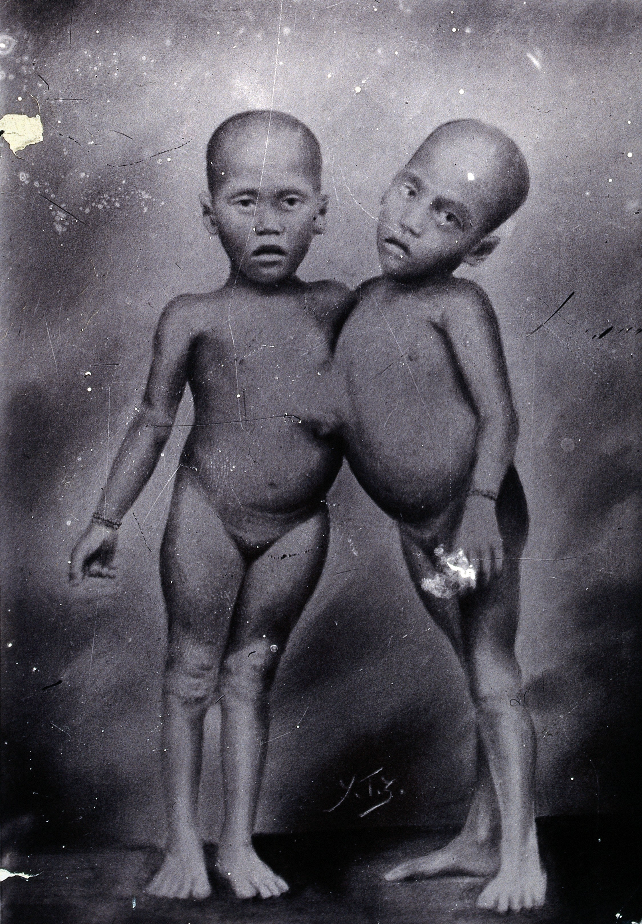 Pics of conjoined twins