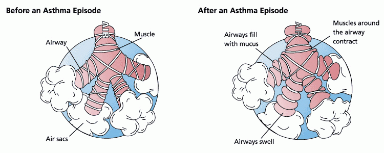 Illustration showing the lungs before and after an asthma episode.