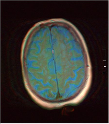 File:Brain MRI 0052 03.jpg