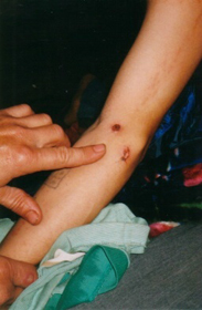 Arm wounds from having been subjected to electrocution