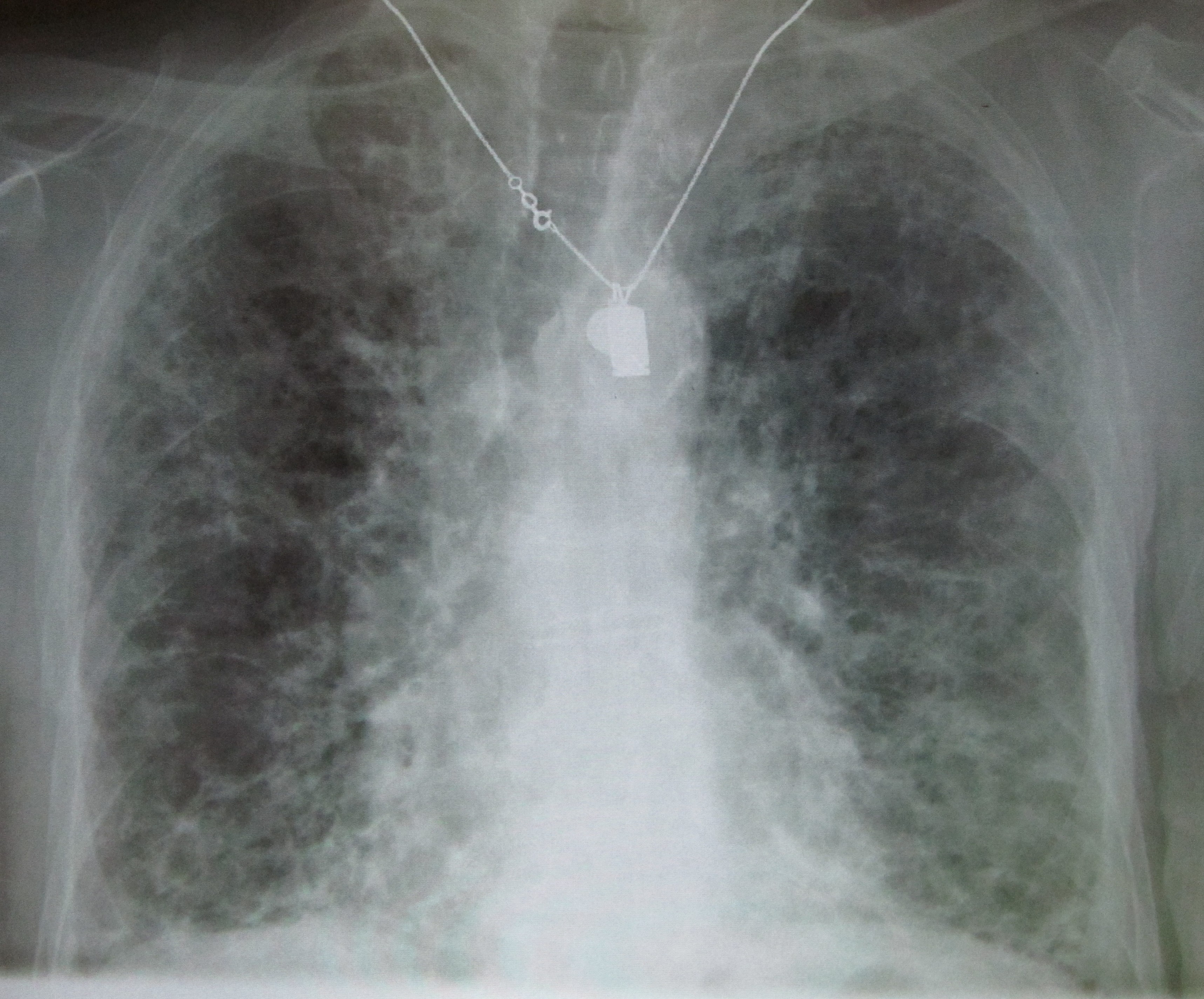 Visible lung fibrosis induced by the heart medication amiodarone