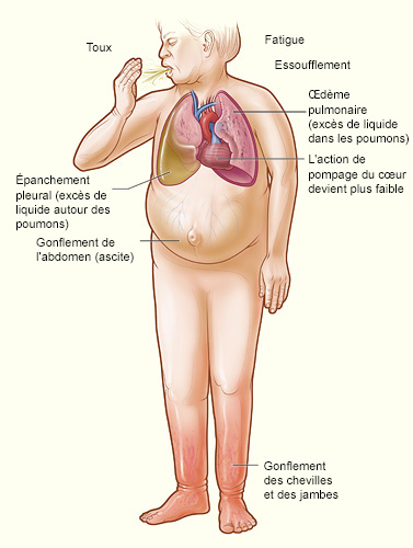 Insuffisance cardiaque chez l humain Wikip dia