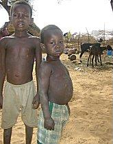 Malnourished children in Niger, during the 2005 famine. Niger childhood malnutrition 16oct06.jpg