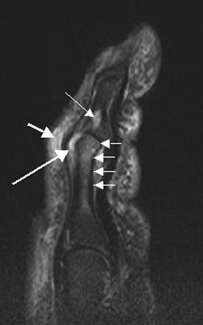 Magnetic resonance image of the سبابة in psoriatic arthritis (mutilans form). Shown is a T2 weighted fat suppressed sagittal image. Focal increased signal (probable erosion) is seen at the base of the middle سلامى (تشريح) (long thin arrow). There is synovitis at the proximal interphalangeal joint (long thick arrow) plus increased signal in the overlying soft tissues indicating استسقاء (طب) (short thick arrow). There is also diffuse bone oedema (short thin arrows) involving the head of the proximal phalanx and extending distally down the shaft.