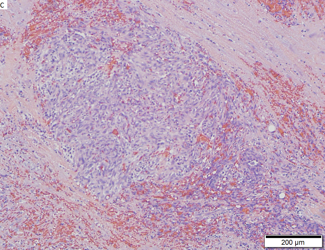 Angiosarcoma of right atrium