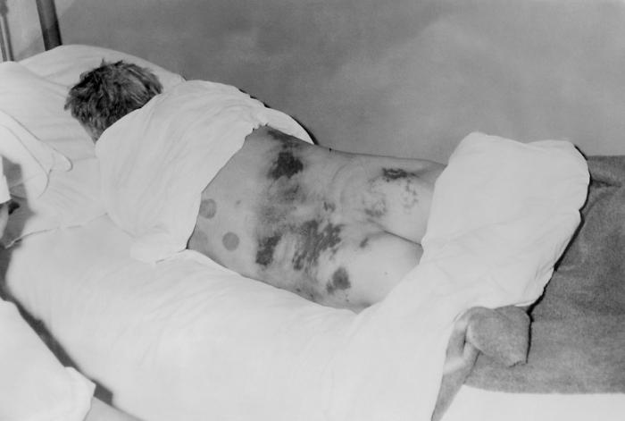 File:Crimean-Congo Hemorrhagic Fever.jpg