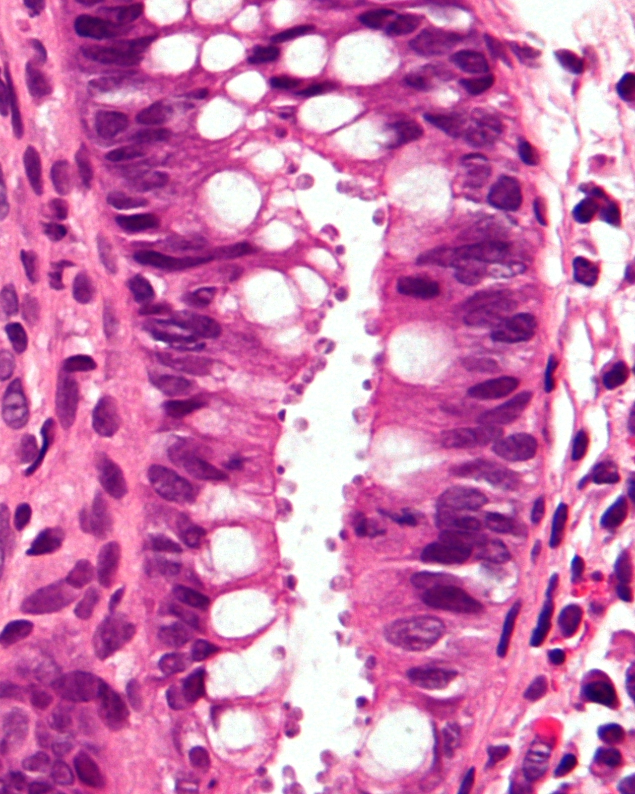 squamous papilloma in the mouth