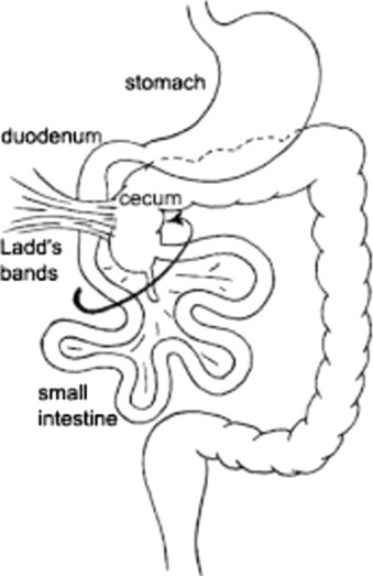 File:Depiction of the Ladd’s band caused by bowel malrotation.jpg