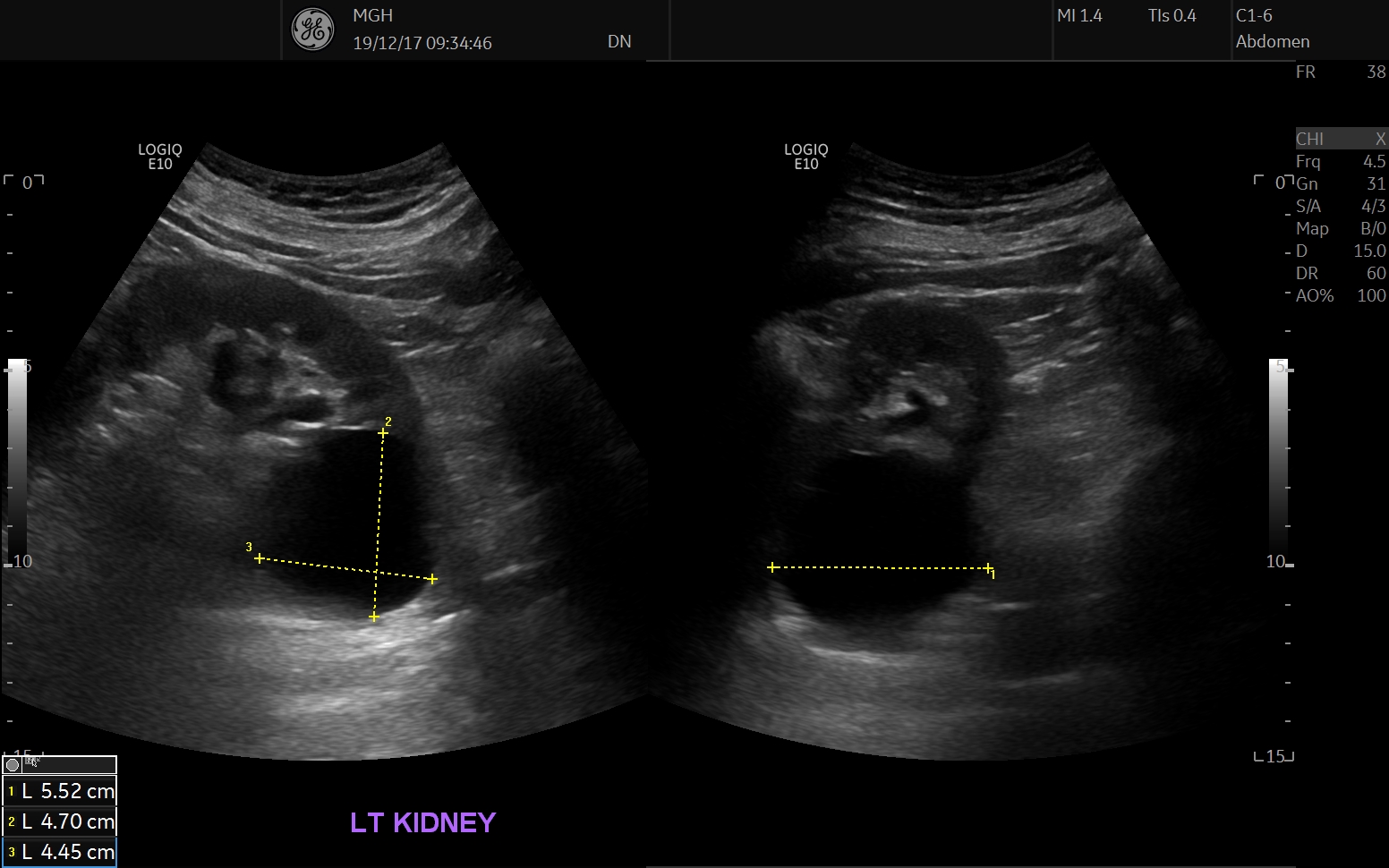 renal cyst ultrasound