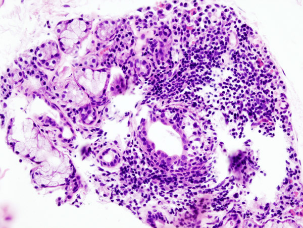 File:Sjogren's syndrome 1.jpg