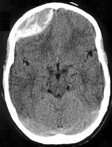 Intracranial Hemorrhage