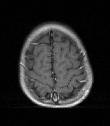 File:Anaplastisches Ependymom - MRT - T1 axial mit KM - 023.jpg