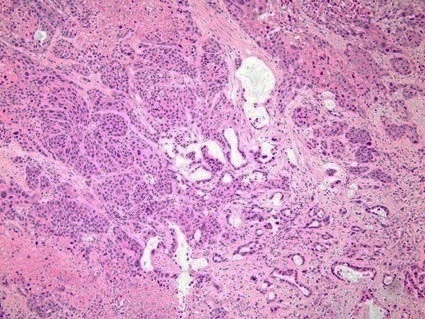 File:Histopathology of adenosquamous carcinoma of the pancreas.jpg