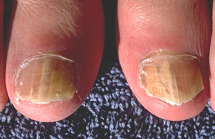 File:Onychomycosis due to Trichophyton rubrum, right and left great toe PHIL 579 lores.jpg