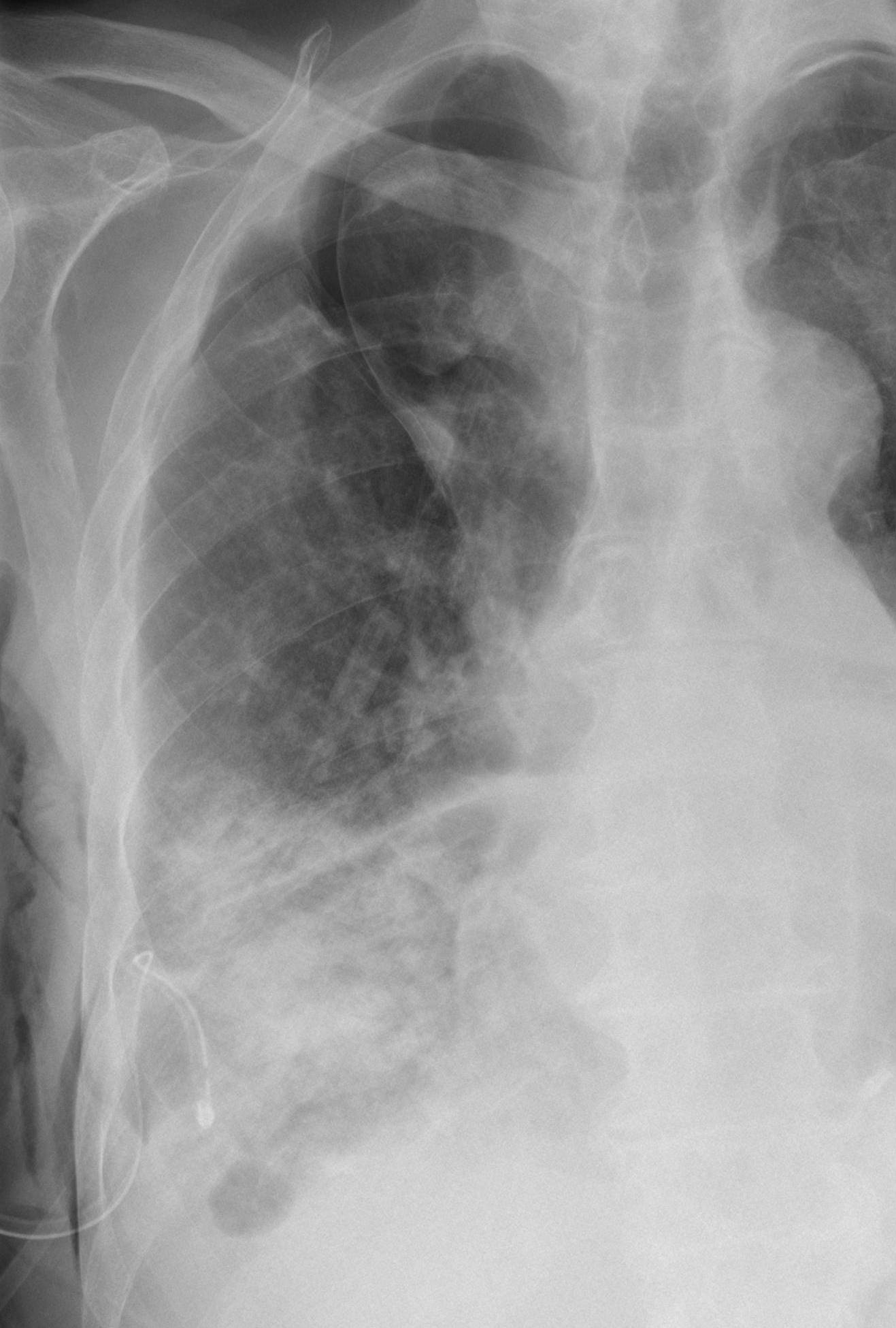 apical pneumothorax chest x ray