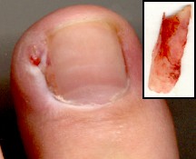 Surgical treatment of ingrown toenails - Wikipedia