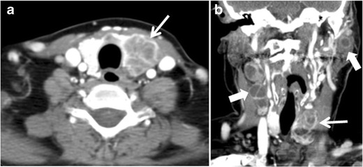 File:Thyroid CT with metastatic squamous cell carcinoma.jpg