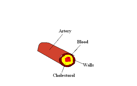 The arteries clogged up with too much cholesterol