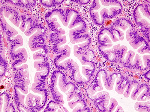 File:Colonic serrated adenoma (2) histopatholgy.jpg