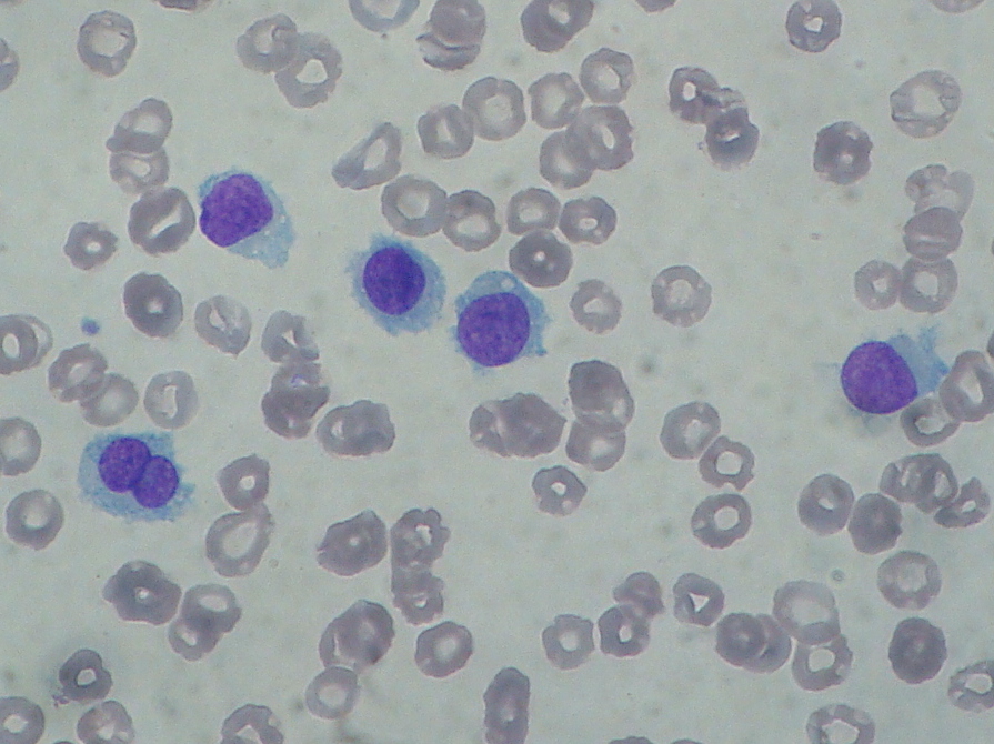 Hairy Cell Leukimia 92