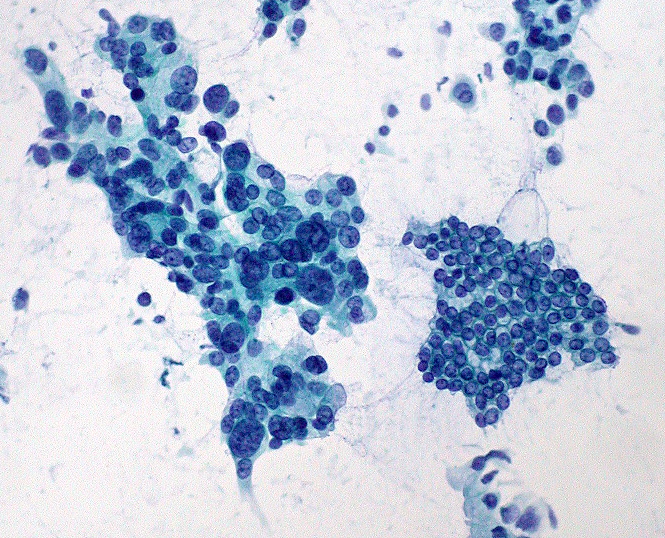 File:Pancreas FNA; adenocarcinoma vs. normal ductal epithelium (200x).jpg
