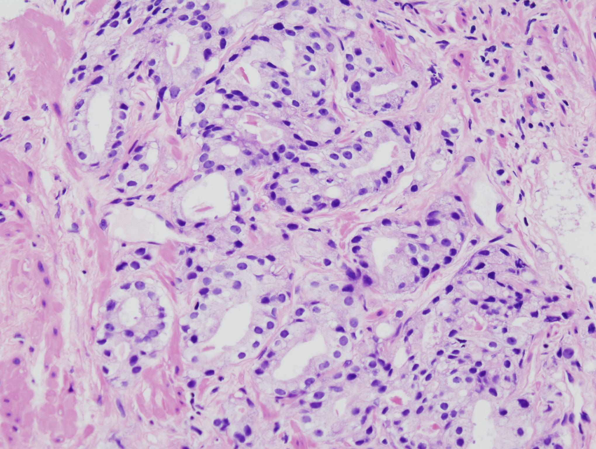 acinar adenocarcinoma prostate)