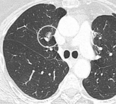 File:CT of part solid lung nodule.png