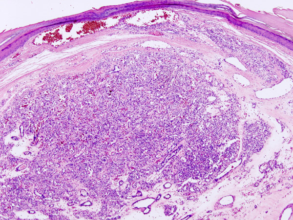 Pathology Outlines - Hemangioma venous diagram 