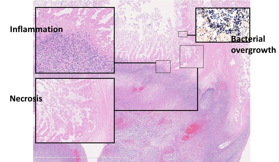 necrotizing enterocolitis histology