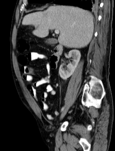 File:Hufeisenniere 03 - CT - sagittal - 009.jpg