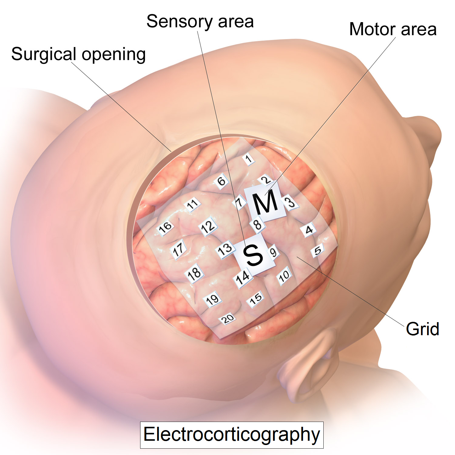 Vital Stim Electrode Placement Chart