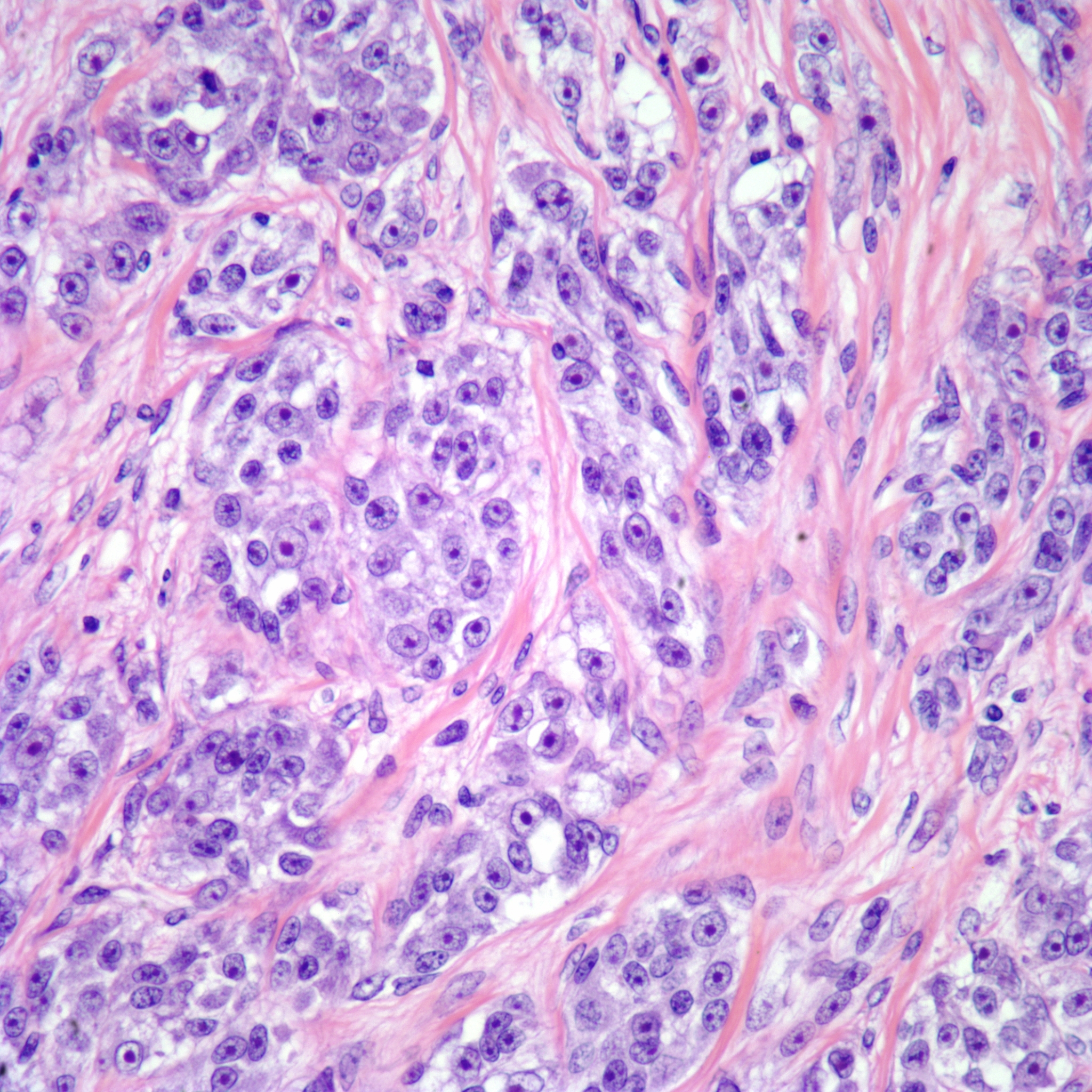 sarcoma cancer cells)