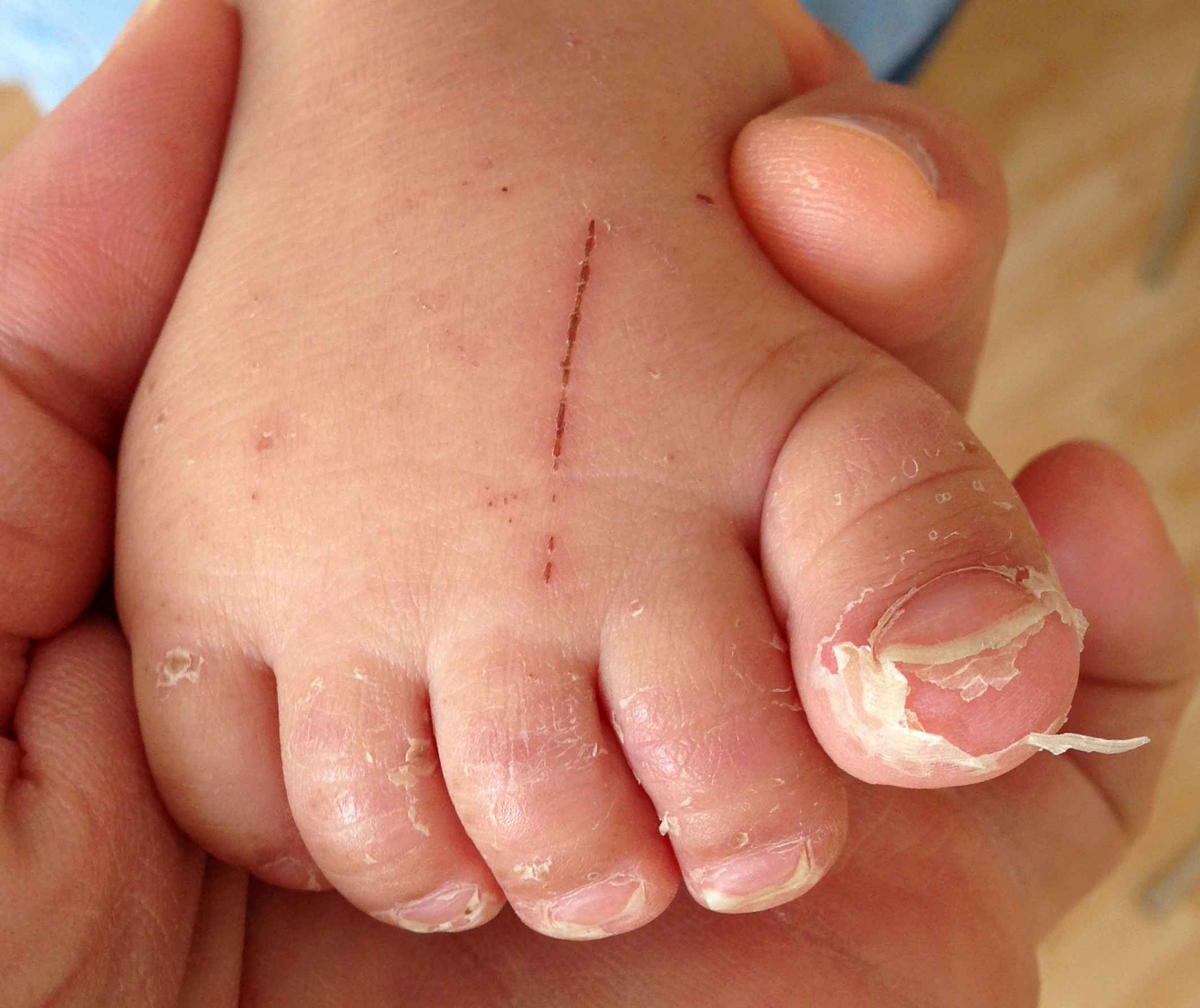 File Desquamation Of The Toes Following A Hand Foot And Mouth Disease 2 Jpg Wikimedia Commons