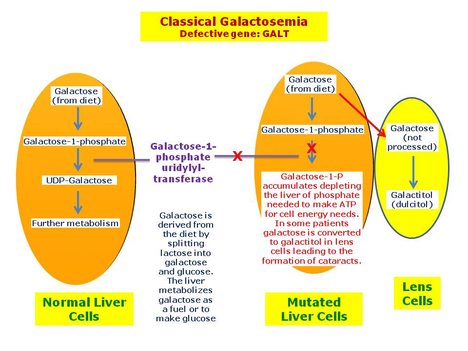 galactosemia