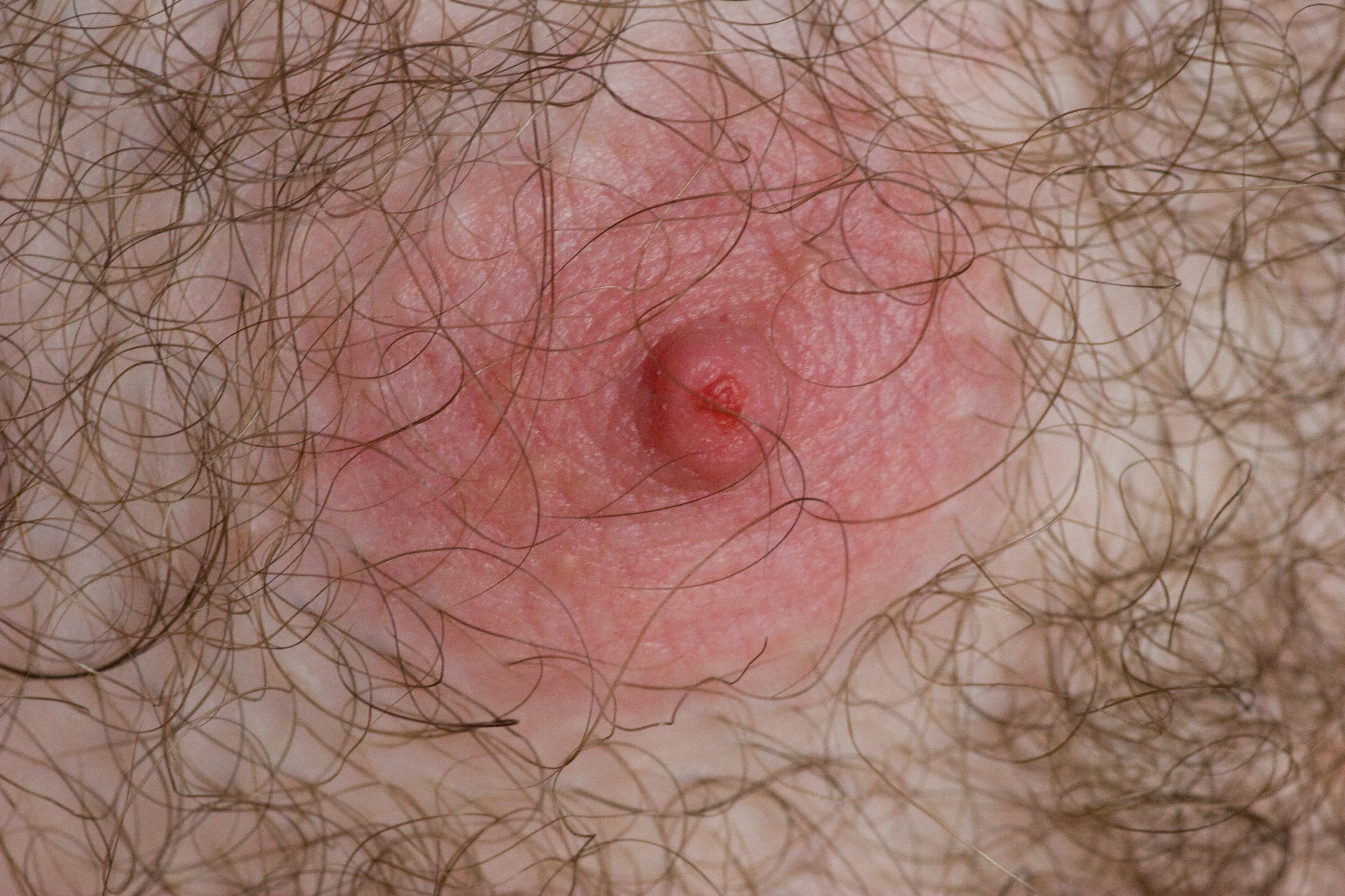 https://upload.wikimedia.org/wikipedia/commons/e/e6/Joggers_nipple.jpg