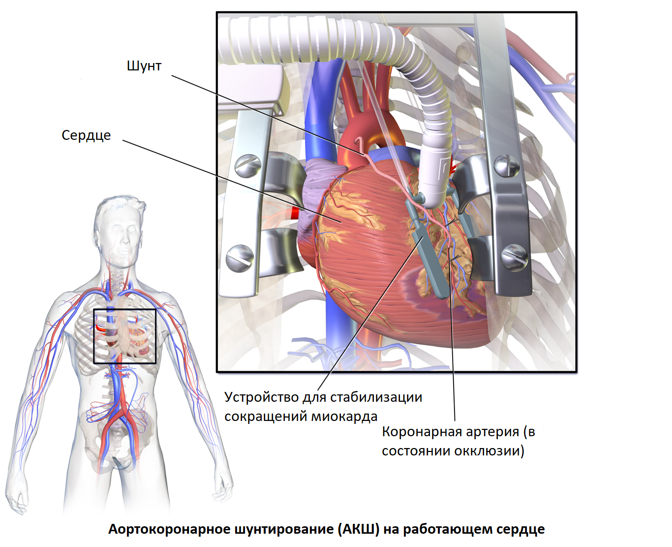 АКШ на работающем сердце — Википедия