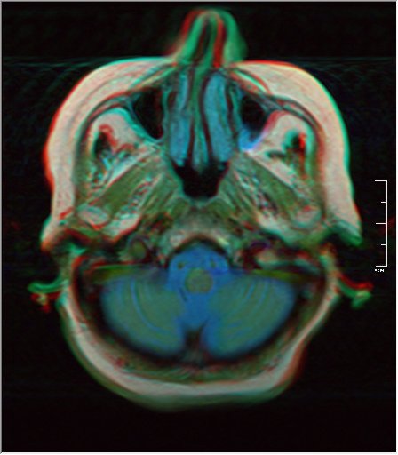 File:Brain MRI 0198 18.jpg