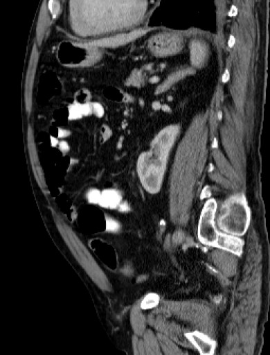 File:Hufeisenniere 03 - CT - sagittal - 033.jpg