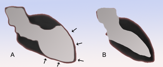 Reversible cardiac dysfunction in long-standing hypertension may be global  variant of stress cardiomyopathy