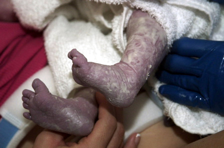 File:Vernix feet.jpg