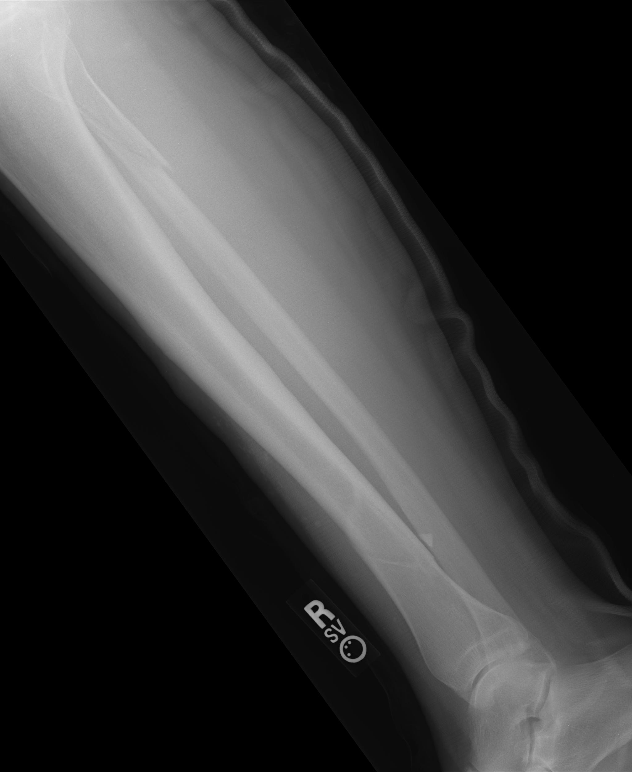 tibia and fibula x ray