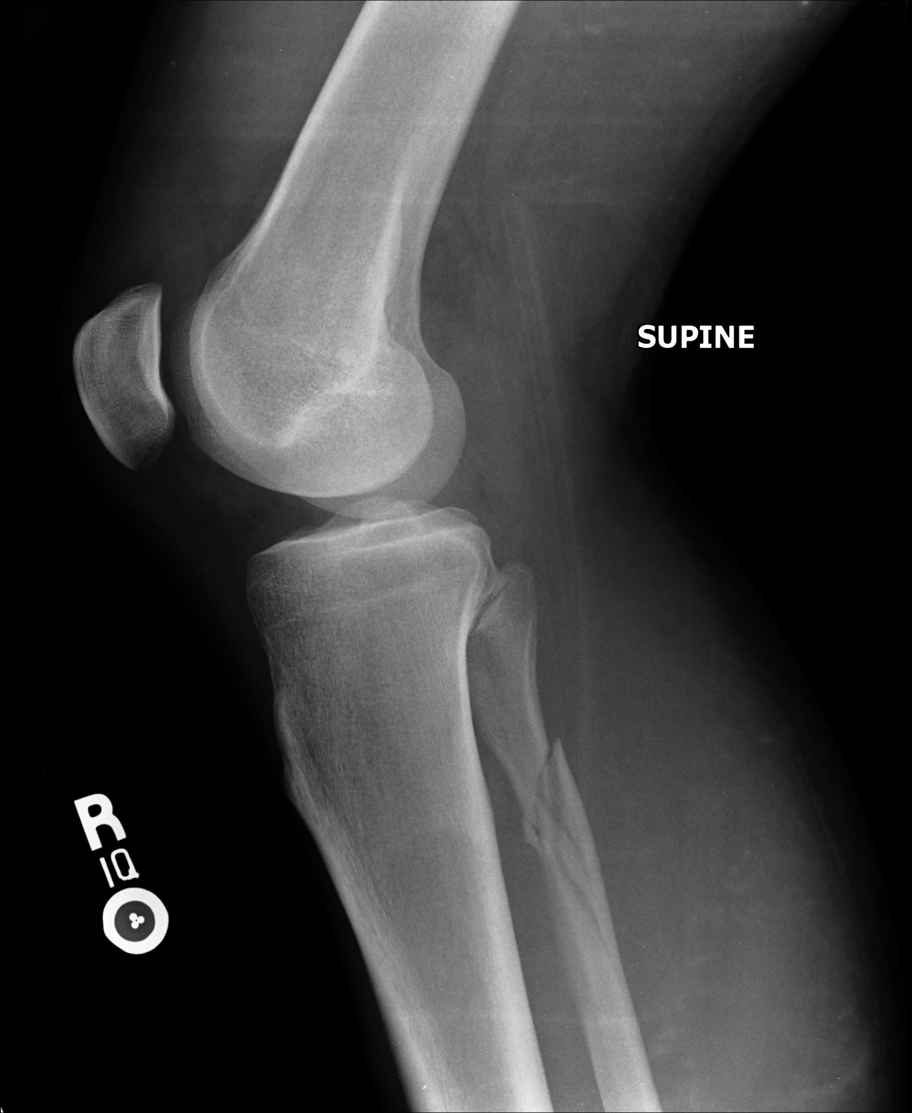 types of fibular fractures